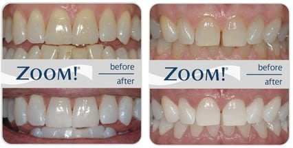 ZOOM Whitening_Before and After_Affordable Dentist_Gentle Dental_Winter Garden Dental_Orlando Dentist
