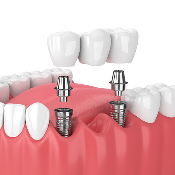 An illustration of a dental implant