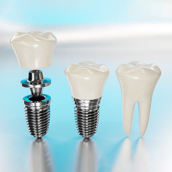 An image showing three stages of an implant. The individual sections, the assembled implant, and an original tooth.