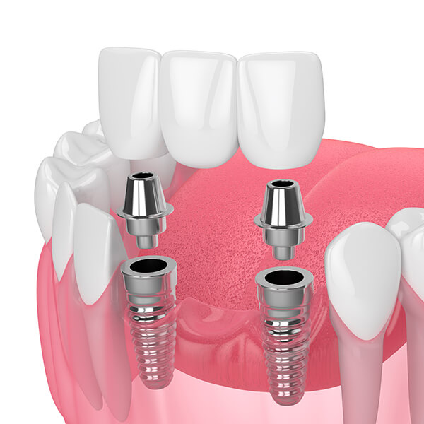 A model shows a dental implant bridge.